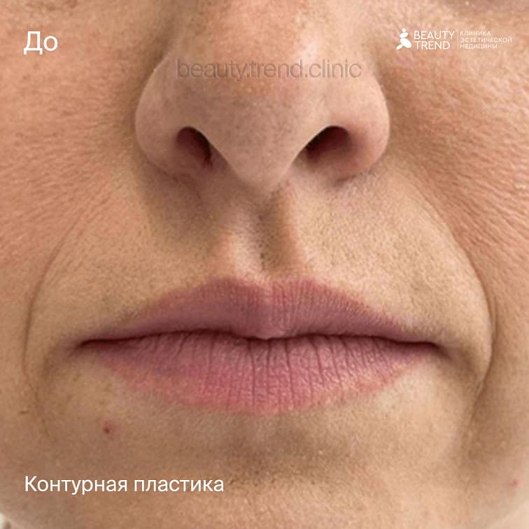 Коррекция носогубных складок - до 1